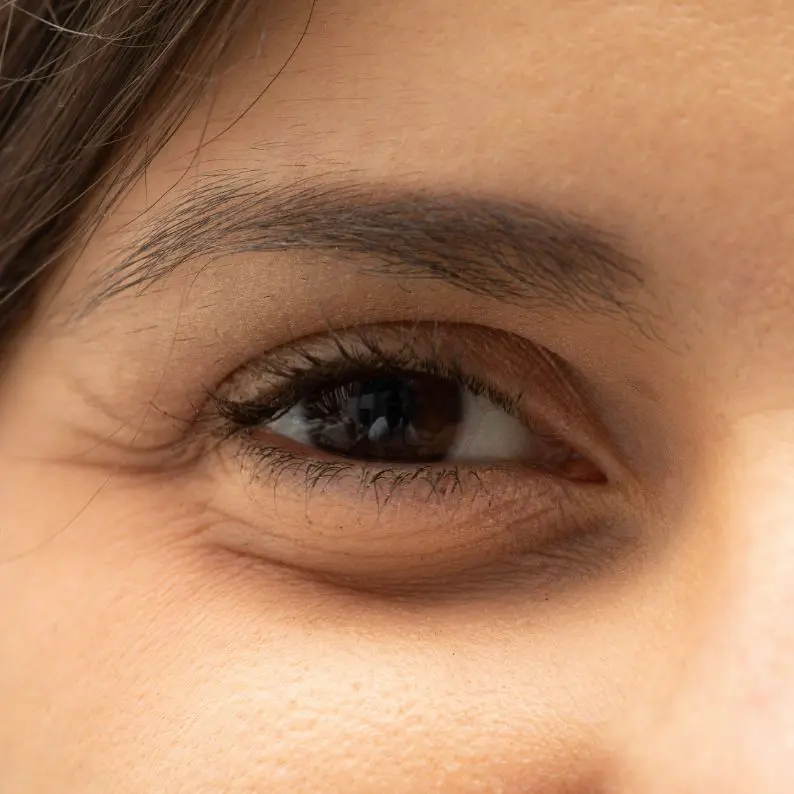 eye bags