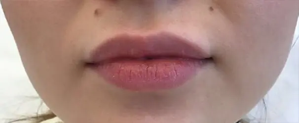 before Dissolving lip Filler