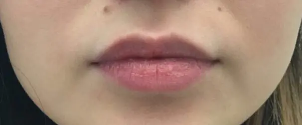 after Dissolving lip filler