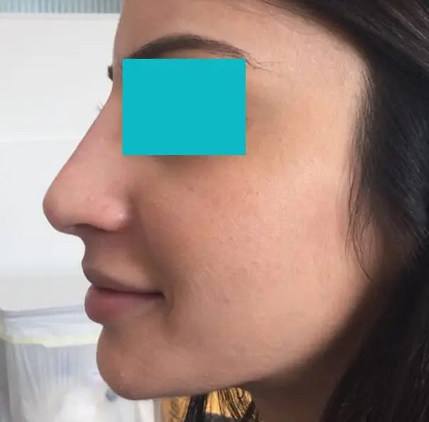 Nose Filler - After 02
