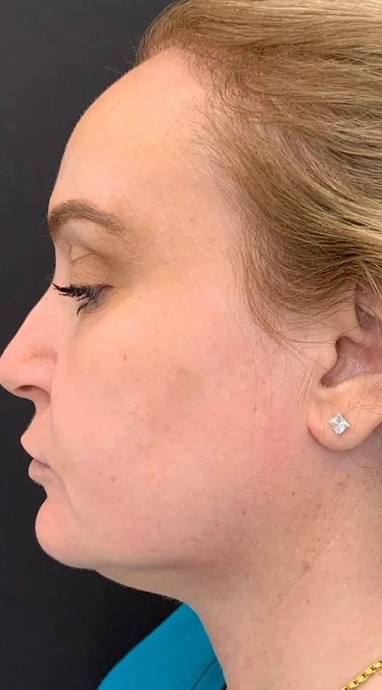 profound rf before and after - after