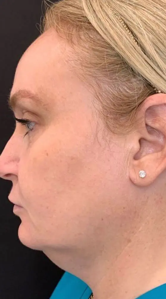 profound rf before and after - before