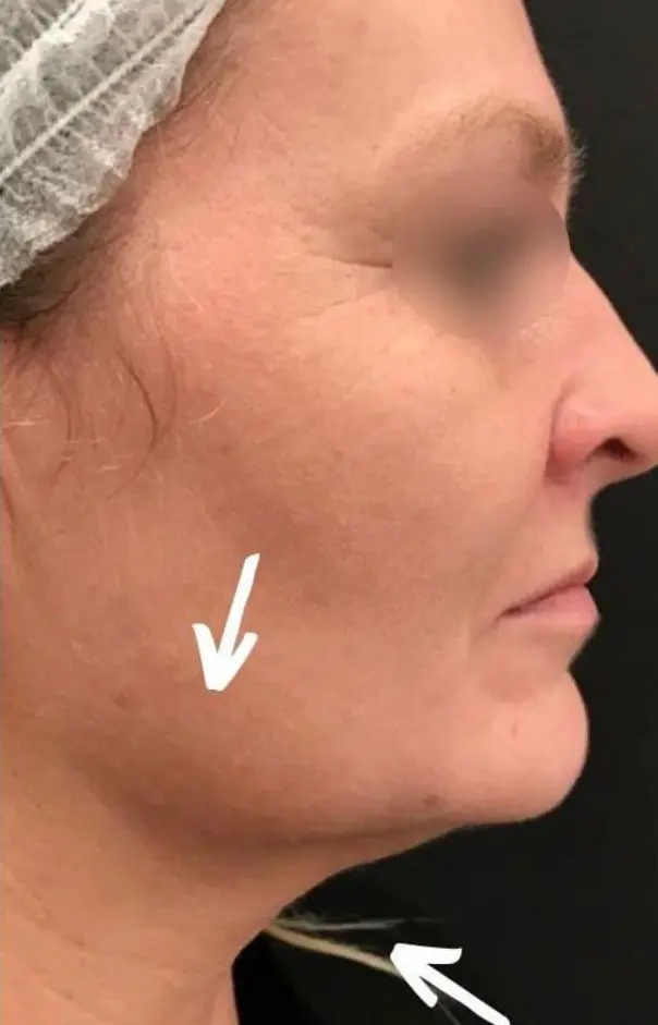 Profound RF after