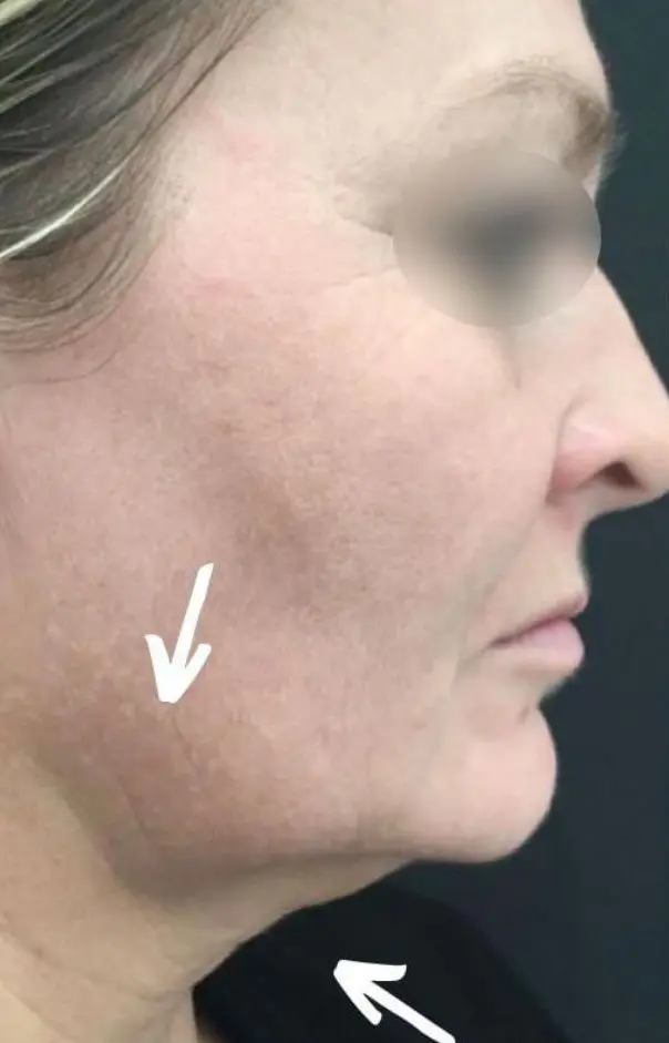 Profound RF before