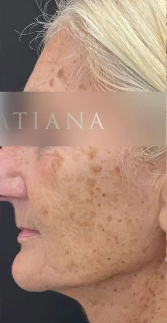 Profound RF before and after treatment 2