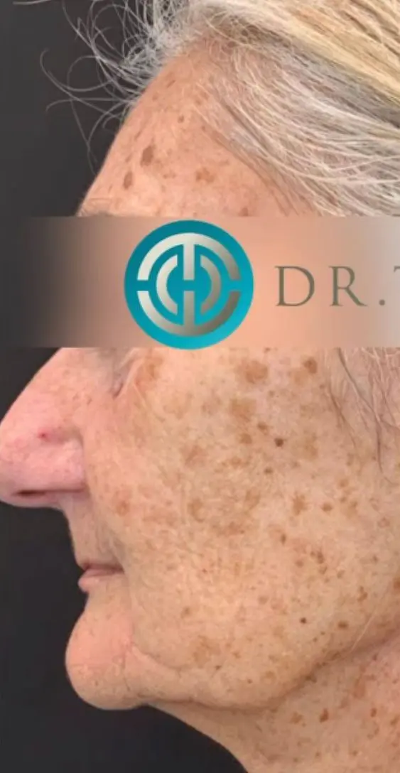 Profound RF before and after treatment