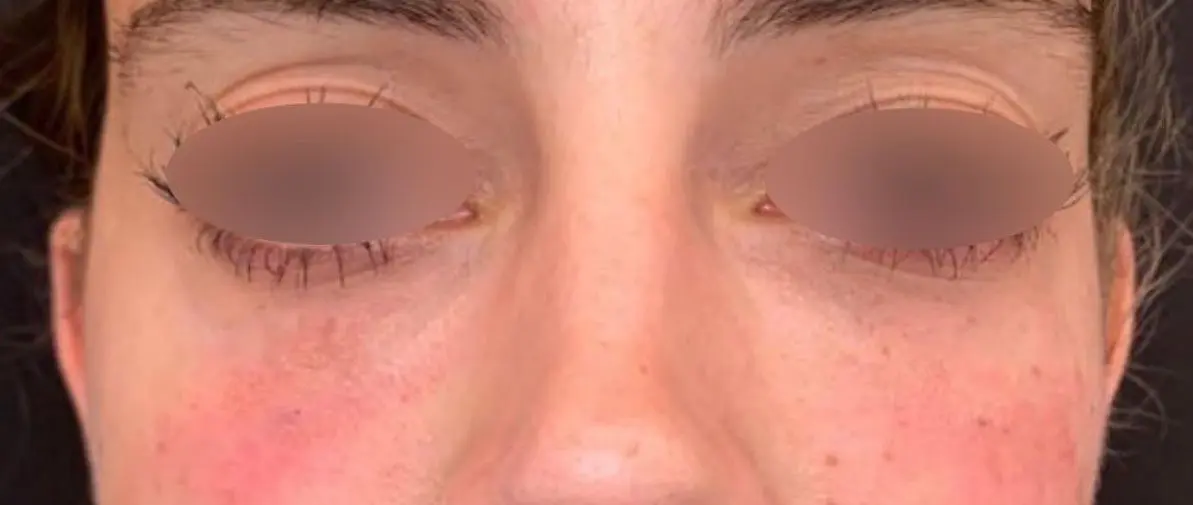 AccuTite, FaceTite, NeckTite, BodyTite and CelluTite