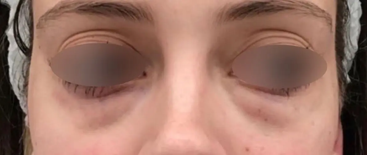 AccuTite, FaceTite, NeckTite, BodyTite and CelluTite