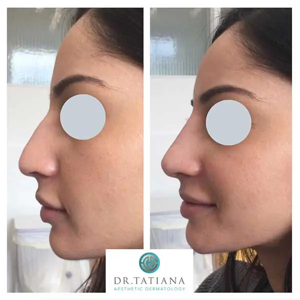 Rhinoplasty Masterclass