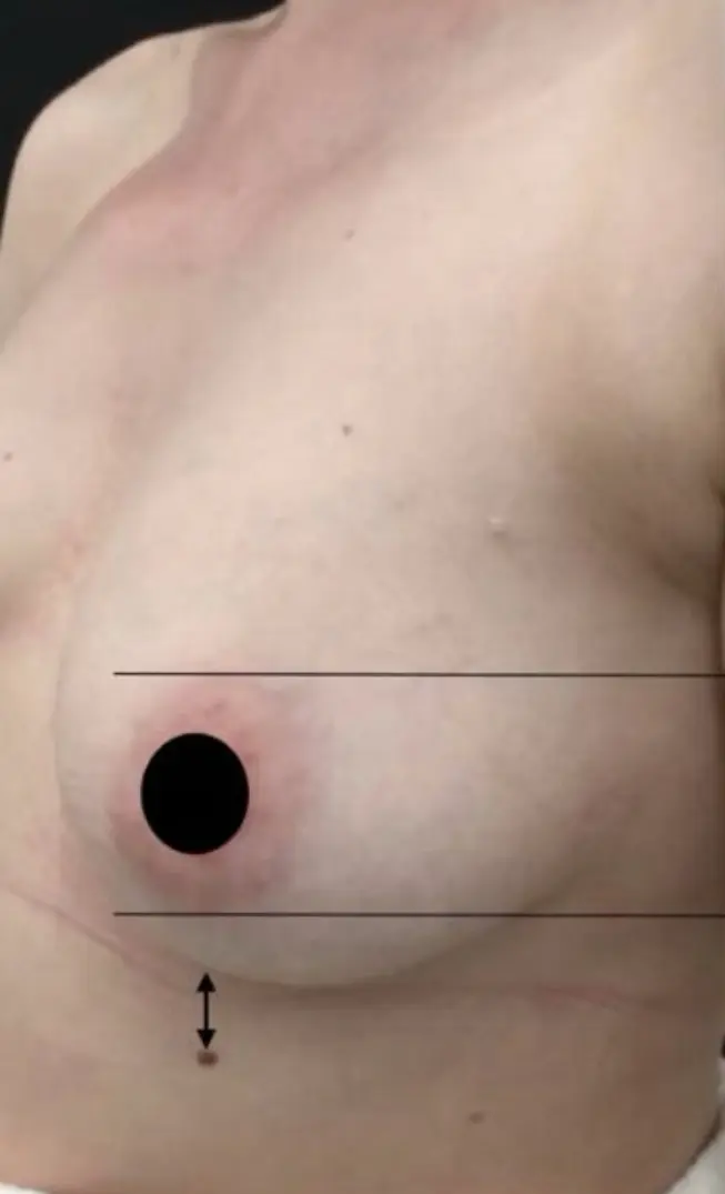 BreastTite before