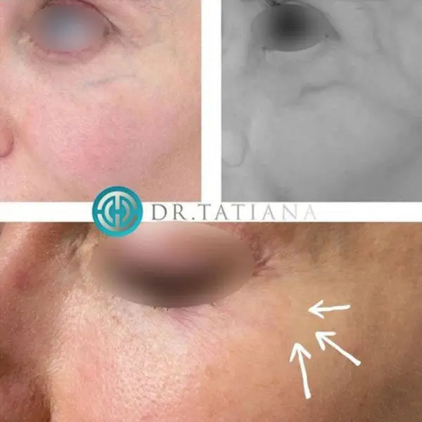 Cutera Laser
