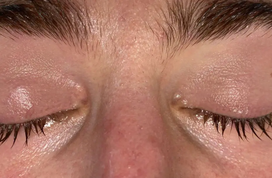 after Periorbital Vein Laser