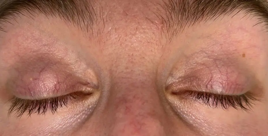 before Periorbital Vein Laser