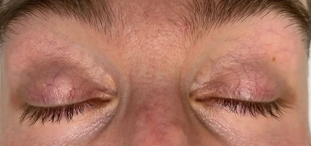before Periorbital Vein Laser