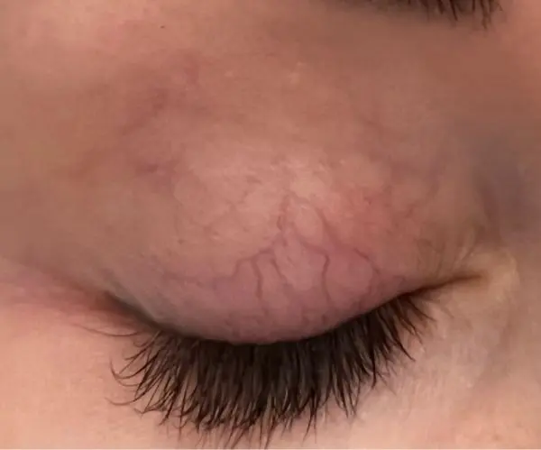 after before eyelid vein removal