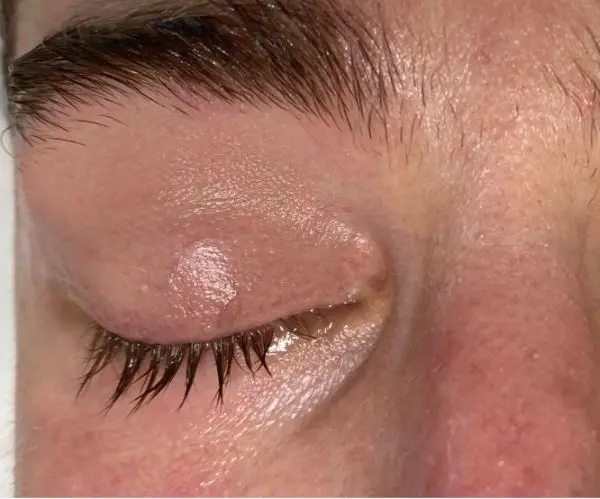 Eyelid / Periorbital Vein Laser