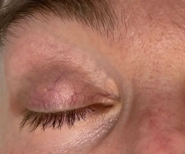Eyelid / Periorbital Vein Laser