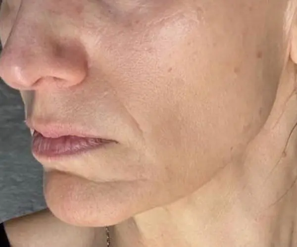 Eyelid / Periorbital Vein Laser