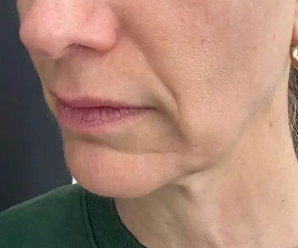 Eyelid / Periorbital Vein Laser
