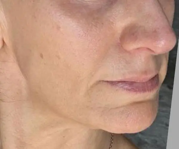 Eyelid / Periorbital Vein Laser