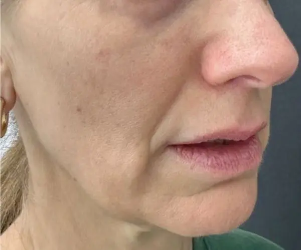Eyelid / Periorbital Vein Laser