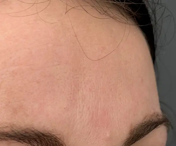 Forehead before