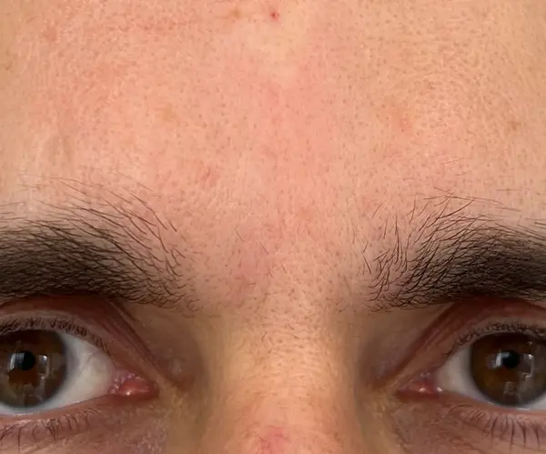 Forehead after
