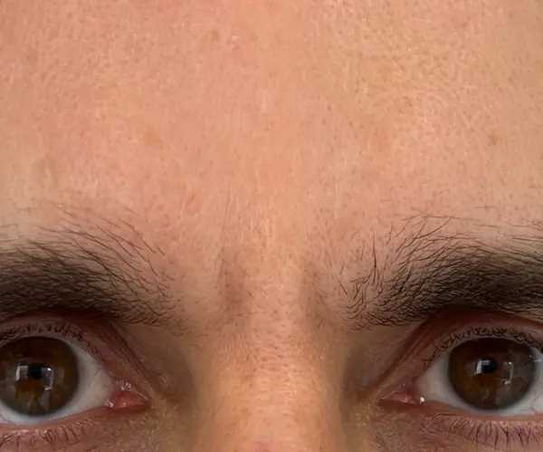 Forehead before