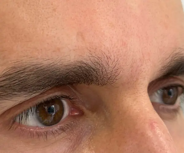 Forehead after