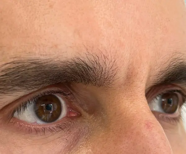 Forehead before