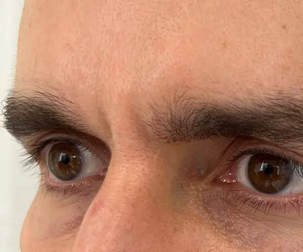Forehead before