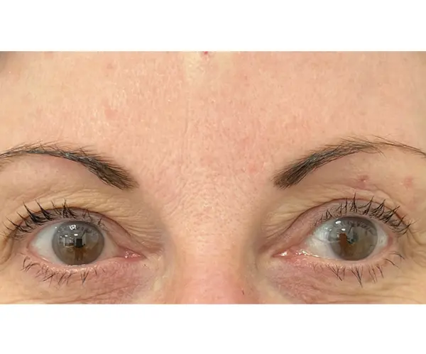 Forehead after