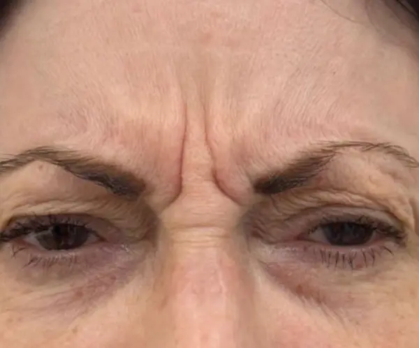 Forehead before