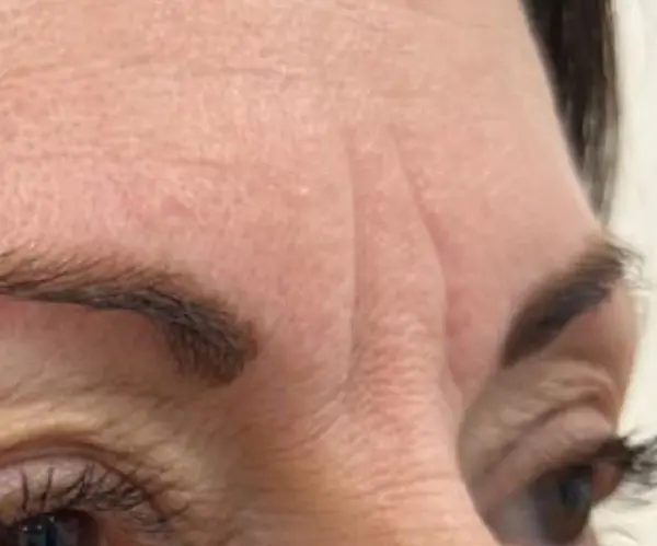 Forehead before