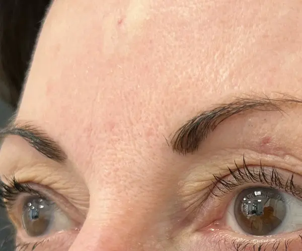 Forehead after