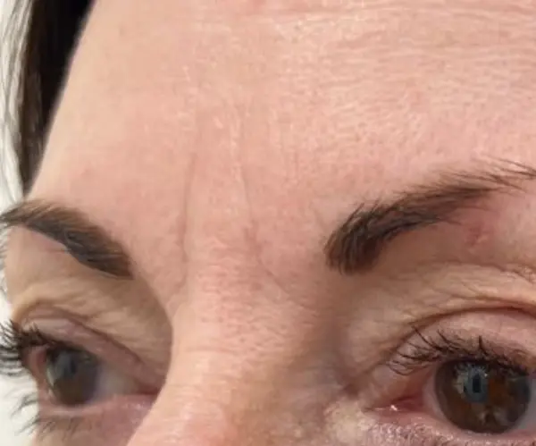 Forehead before