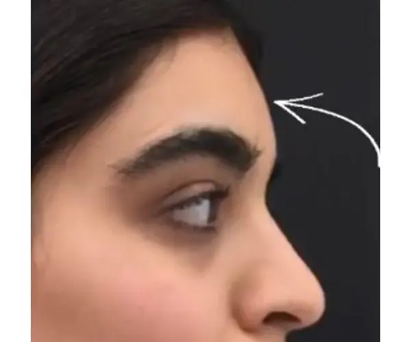 Forehead after