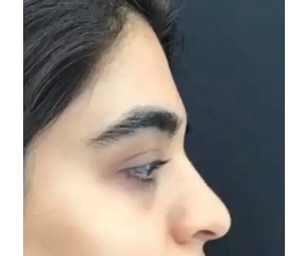 Forehead before