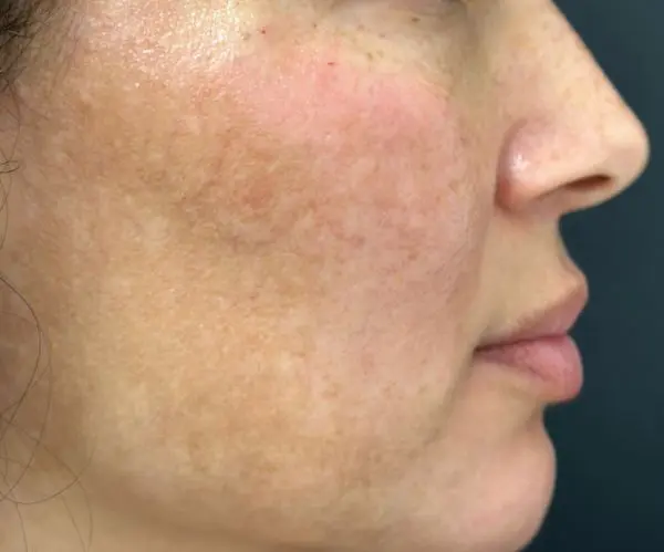 Melasma Facial after