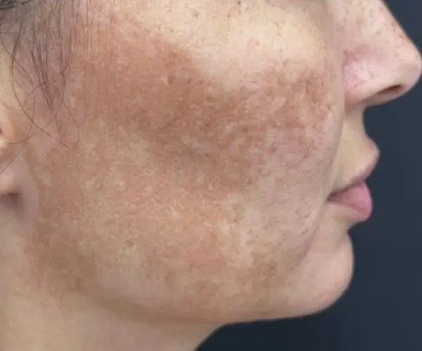 Melasma Facial before