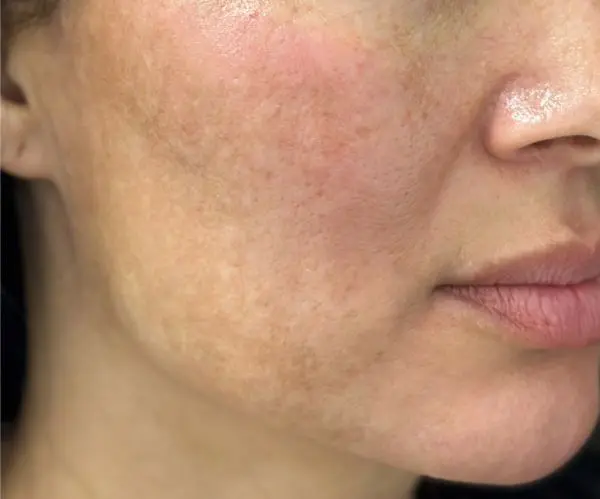Melasma Facial after
