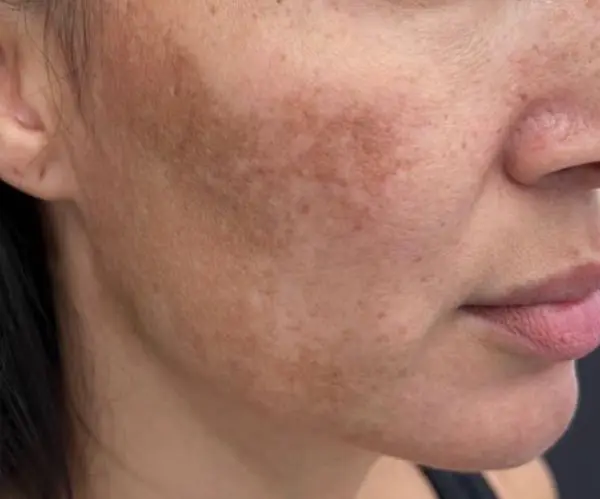 Melasma Facial before