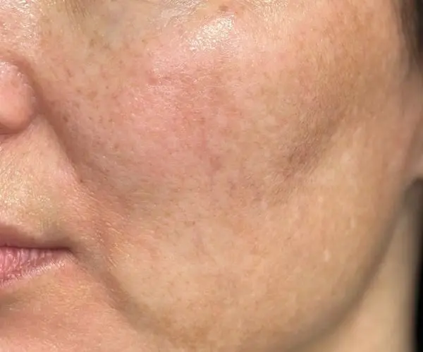Melasma Facial after