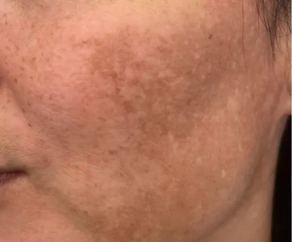 Melasma Facial before