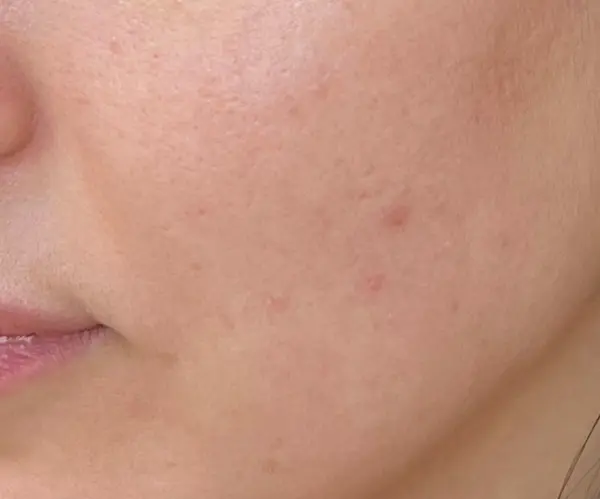 PicoFX Resurfacing therapy after
