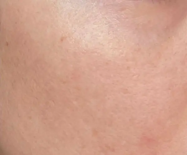 PicoFX laser after