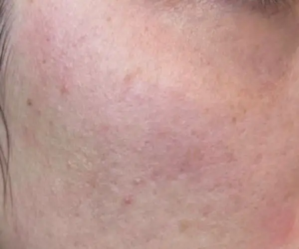 PicoFX laser before