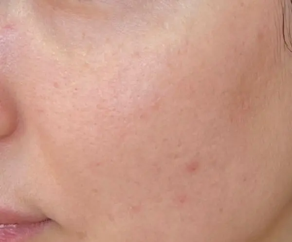 PicoFX laser after