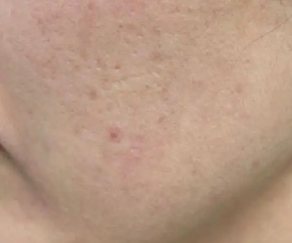 PicoFX laser before