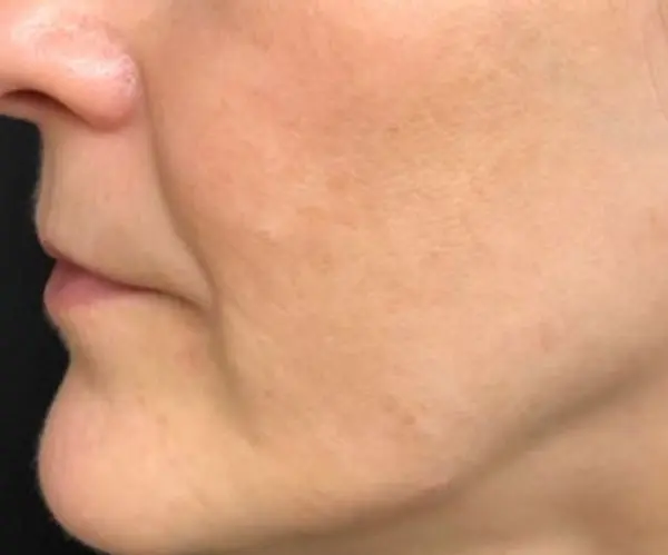 Pigmentation Facial after